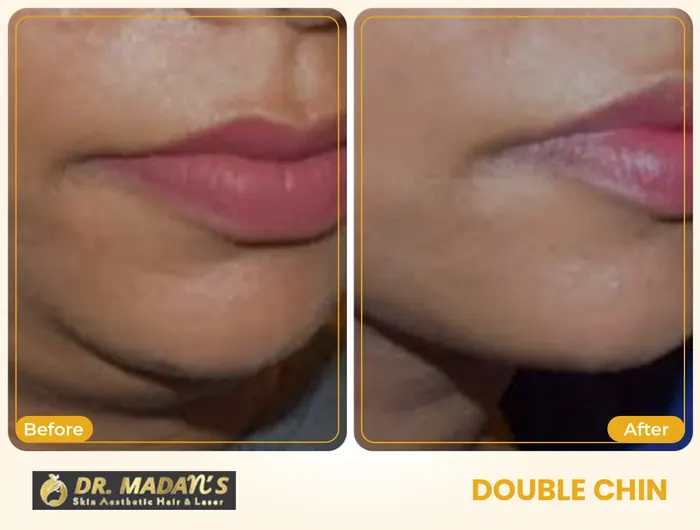 Double chin before and after result 1 at Dr Madan Aesthetics